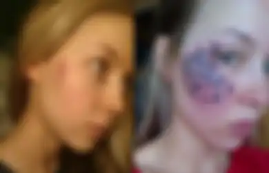 Molly Martinson, Blogger Kecantikan yang Mendapat Luka Bakar di Wajahnya Setelah Operasi Laser