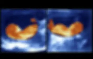 Bayi Kembar di Vietnam Ini Diketahui Memiliki Ayah Berbeda Setelah Menjalani Tes DNA