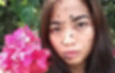 Meski Dijuluki Monster Gara-gara Tubuhnya Dipenuhi Tahi Lalat, Gadis Ini Tetap ‘Pede’ Ikut Audisi Miss Universe