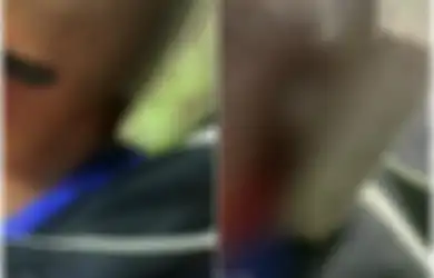 Sedih, Anak dengan Autisme Ini Tidak Hanya Di-bully Tapi juga Dilempari Papan Berpaku Hingga Menancap di Kepalanya