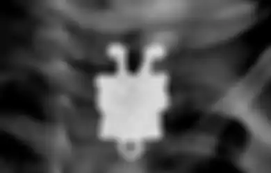 Dari Spongebob Sampai Ponsel, Inilah 7 Benda Aneh yang Pernah Bersarang di Tubuh Manusia yang Terdeteksi X-ray