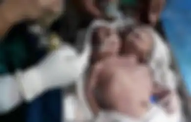 Sedih, Bayi Kembar Siam Dengan Dua Kepala dan Satu Tubuh Ini Hanya Bisa Bertahan Hidup Selama 24 Jam Saja