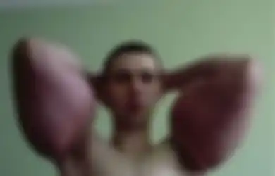 Malas Pergi ke Gym, Kirill Suntikkan Minyak Sintesis ke Lengannya Agar Terlihat Seperti Popeye