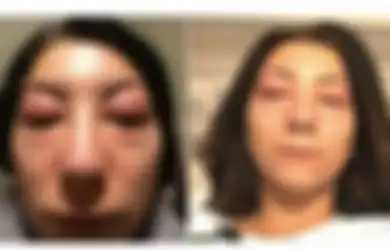 Ngeri! Niat Hati Ingin Menyambung Bulu Mata, Wanita Ini Jutsru Alami Alergi Parah
