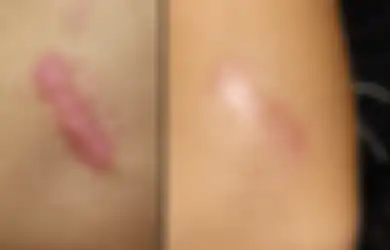 Punya Keloid Bekas Luka? 3 Bahan Rumahan Ini Ampuh Menyamarkannya, Coba dan Buktikan!