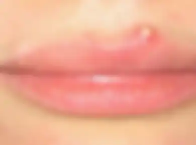 5 Cara Hilangkan Jerawat di Area Bibir, Dijamin Ampuh dan Flawless