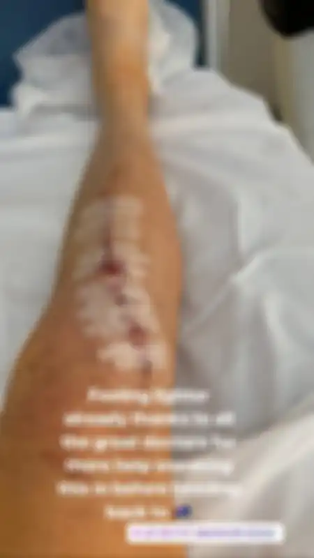 Kondisi kaki kanan Jack Miller setelah dioperasi