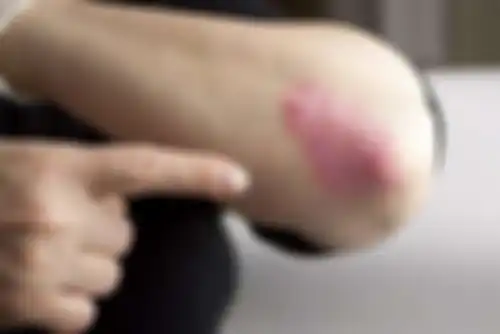 gejala autoimun: inflamasi 