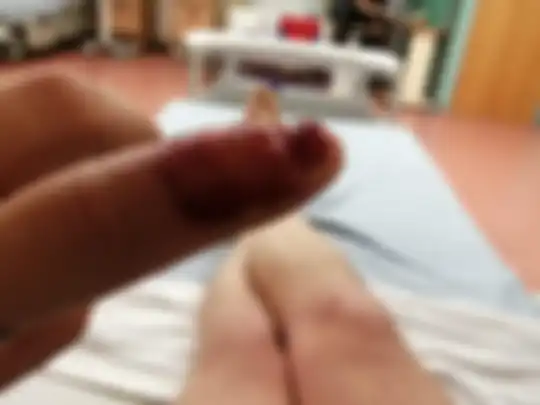 Jari tangan teman Karen yang mengalami infeksi karena kebiasaan gigit kuku.