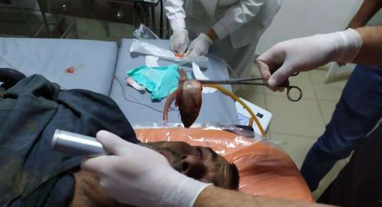 Dokter berhasil mengeluarkan ikan dair tenggorokan nelayan.