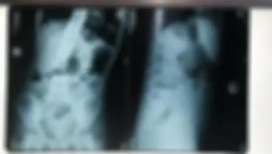Hasil scan medis menunjukkan teratoma di dalam perut gadis tersebut.