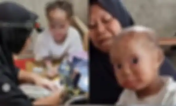 Kakak-beradik yang menderita penyakit kulit langka