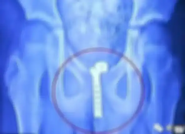 Hasil x-ray