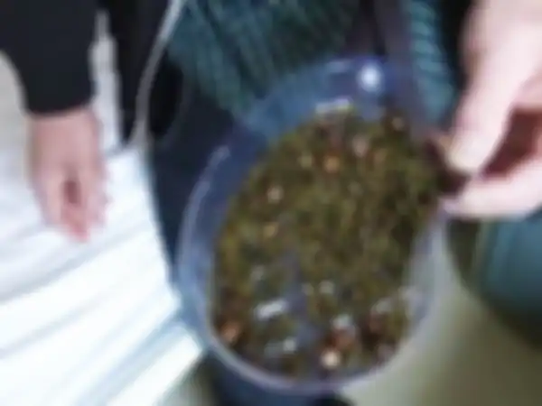 Tak Pernah Sarapan dan Jarang Minum, Wanita Tiongkok Ini Temukan 2000 Batu Empedu di Tubuhnya