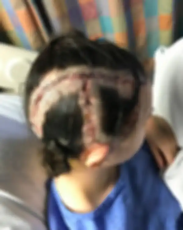 Chloe menjalani operasi aneurisma otak