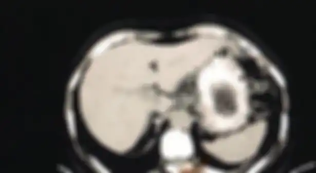 Ini adalah hasil rekaman endoskopi di mana dokter menemukan benda asing di dalam perut wanita ini.