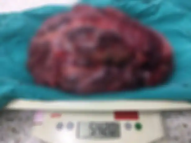 Tumor itu seberat 5 kg