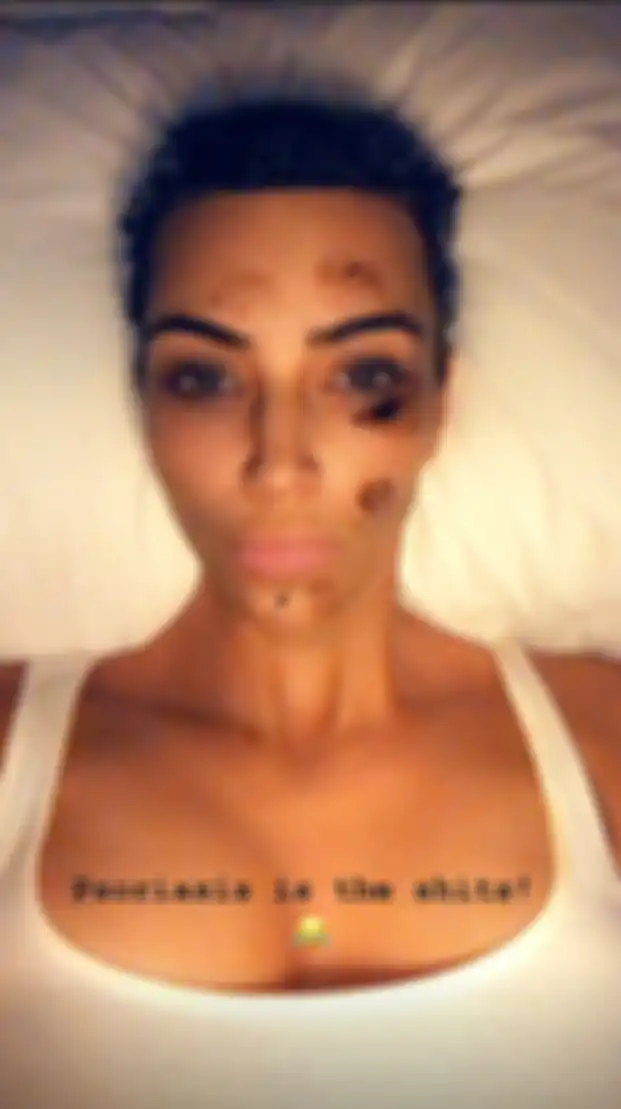 Kim Kardashian sakit kulit psoriasis