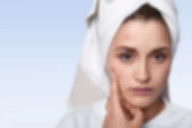 Manfaat dan Cara Kerja Niacinamide untuk Mengatasi Bekas Jerawat