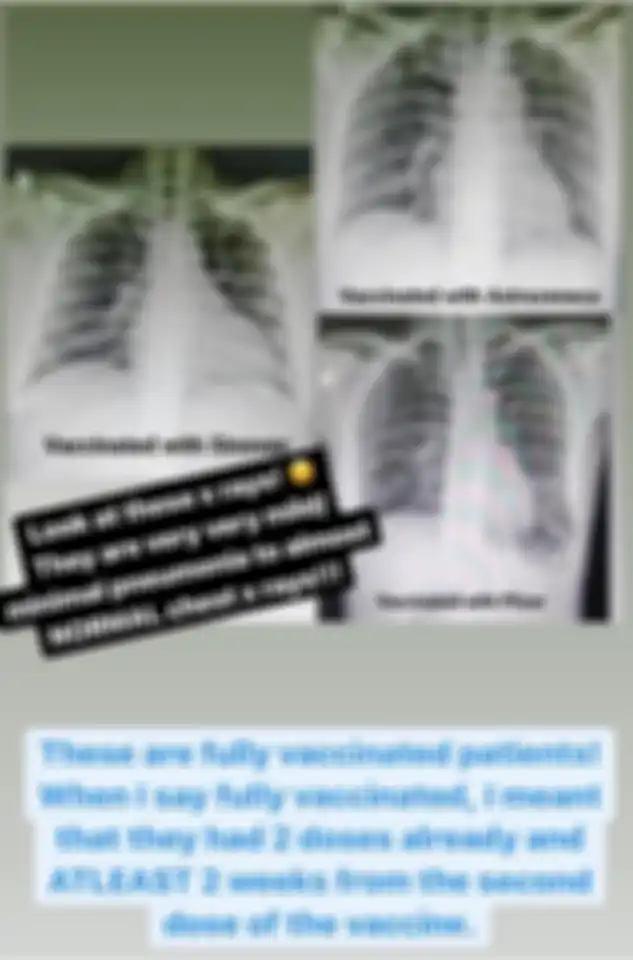Foto unggahan seorang dokter bernama Dr. Anne Gabriel-Chan menunjukkan hasil rontgen paru-paru orang yang terinfeksi covid-19, yang vaksin dan yang tidak vaksin. 