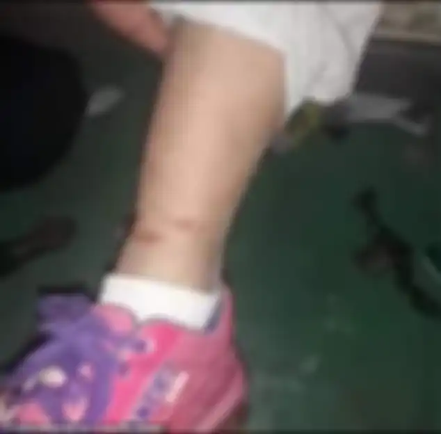 Kondisi kaki gadis memar karena jeratan rantai