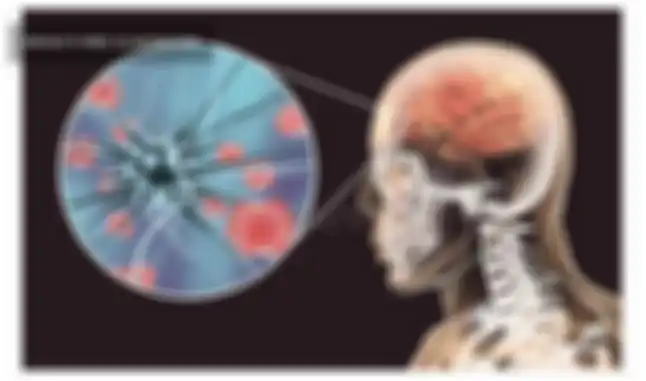 Ilustrasi Meningitis