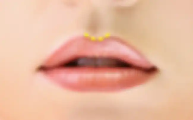 Bibir atas dengan philtrum bulat