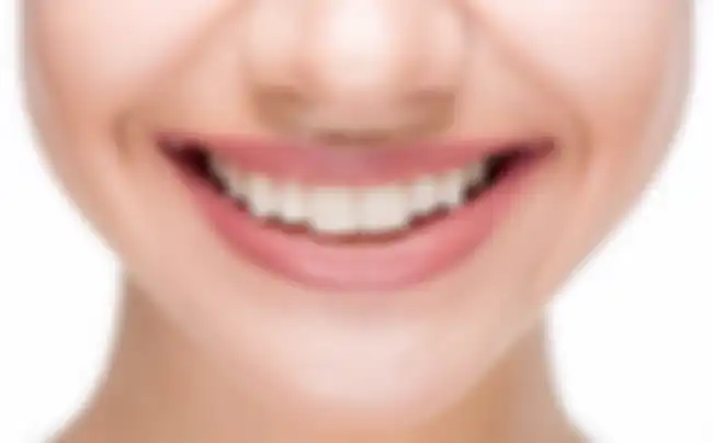  Bibir atas tanpa philtrum