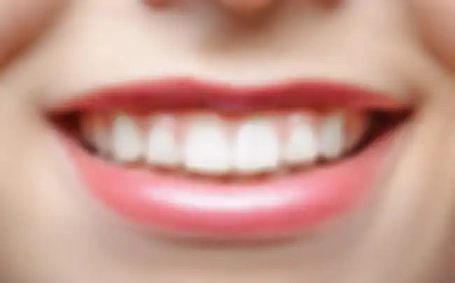 Bibir atas yang sangat tipis