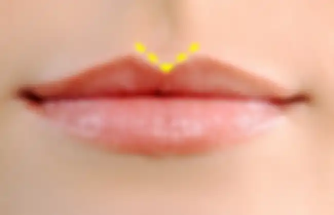 Bibir atas dengan philtrum yang tajam