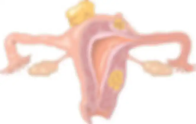 Peradangan yang terjadi akibat endometriosis dapat merusak sel telur dan sperma. Kondisi ini tentunya mengganggu kesuburan dan dapat menghalangi terjadinya pembuahan.