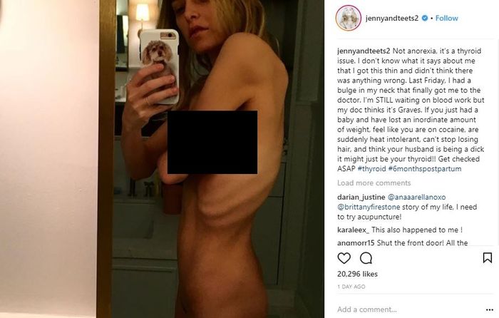 Efek dari penyakit Graves yang dialami Jenny Mollen