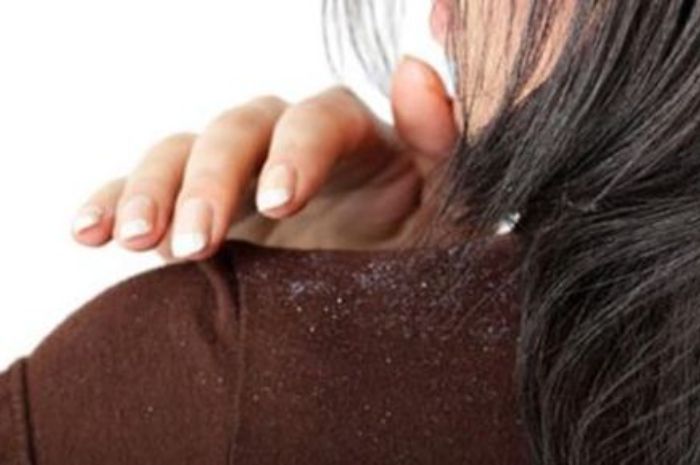 Masalah rambut yang kerap dialami setiap orang adalah ketombe