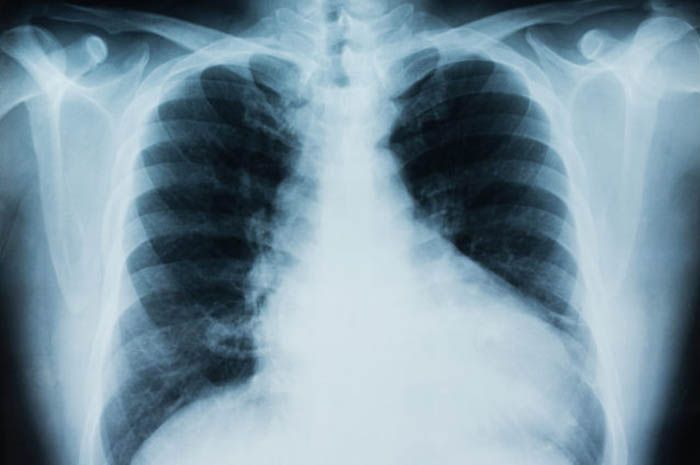 Ilustrasi Kanker Paru-paru