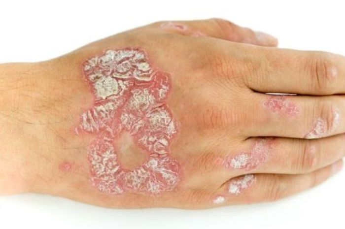 Plaque Psoriasis