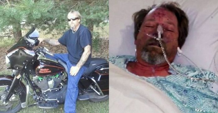 Kaki dan Tangan Greg Diamputasi Setelah Terserang Bakteri Patogen yang Diduga Berasal dari Liur Anjing