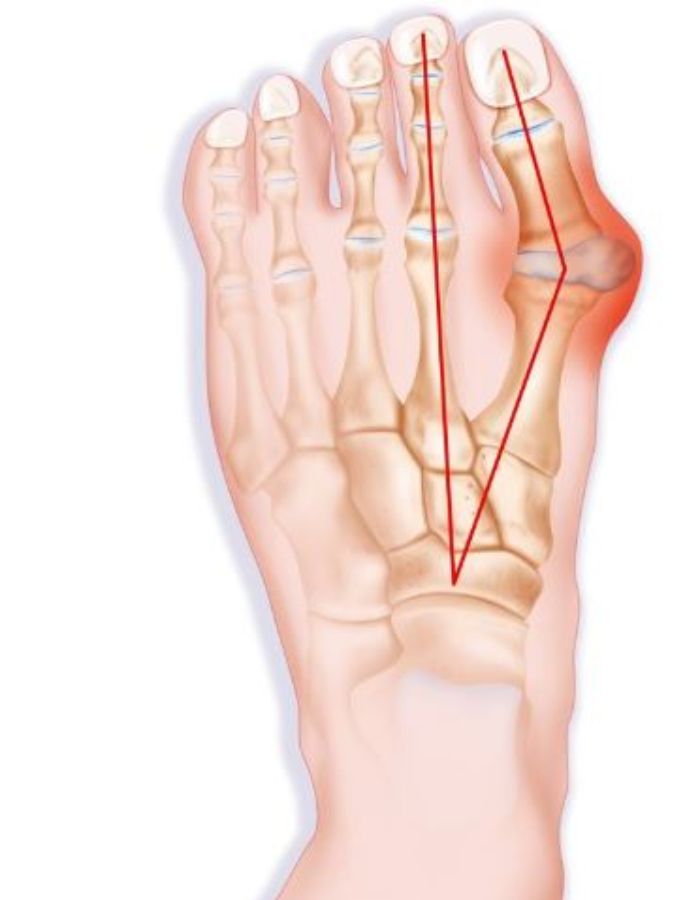 Bunion di kaki