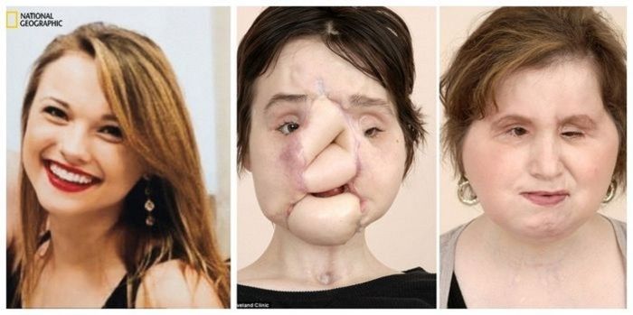 operasi transpalasi wajah