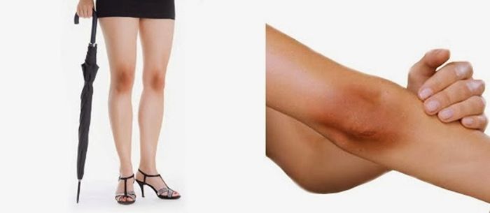 Lutut dan Siku Gelap