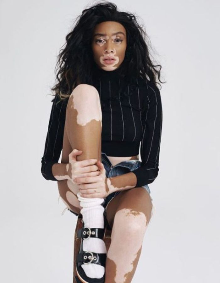 Winnie Harlow