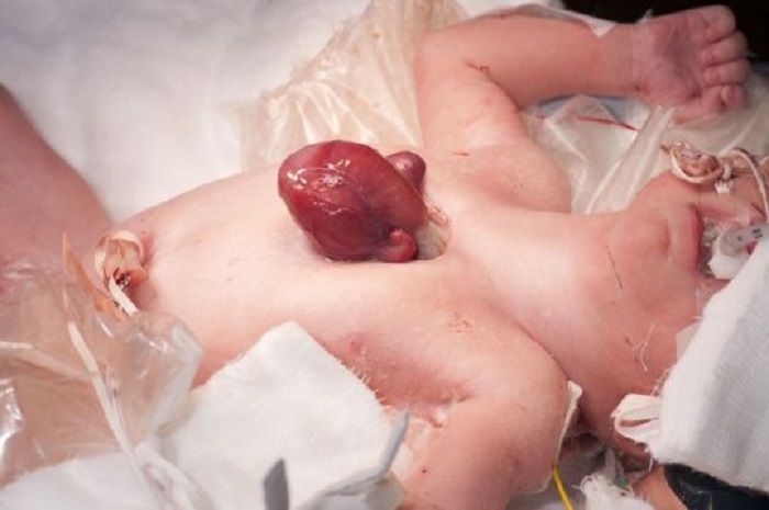 Kondisi Vanellope saat lahir