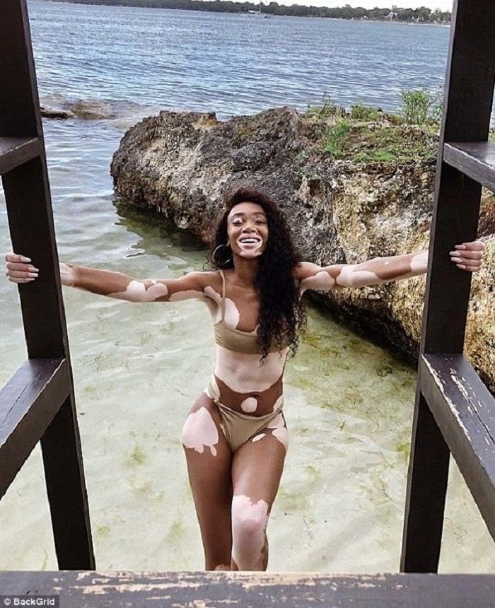 Winnie Harlow.