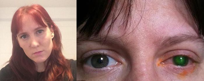 Emma Jenkis - kondisi mata Emma yang terinfeksi bakteri