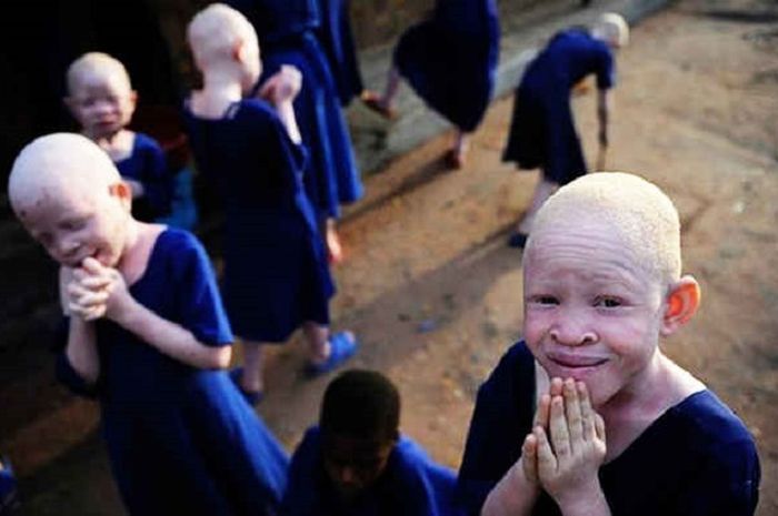 Orang albino di Afrika