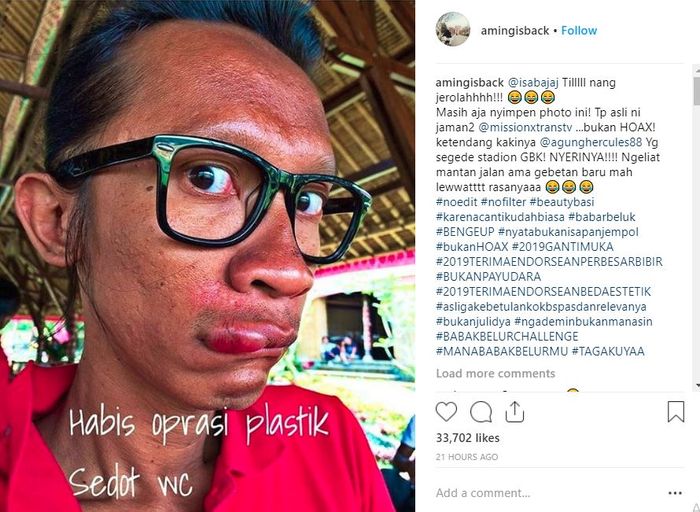 Aming posting foto wajah lebam dan bibir bengkak akibat terkena tendangan Agung Hercules