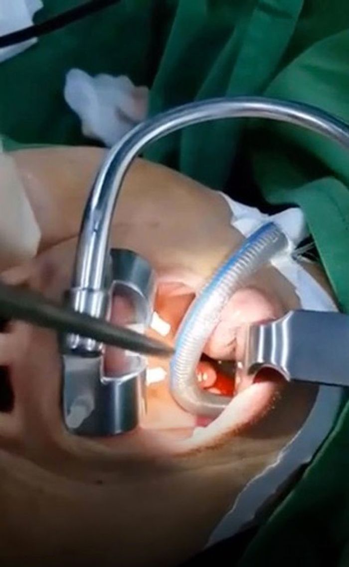 Ada lintah di sinus wanita ini.