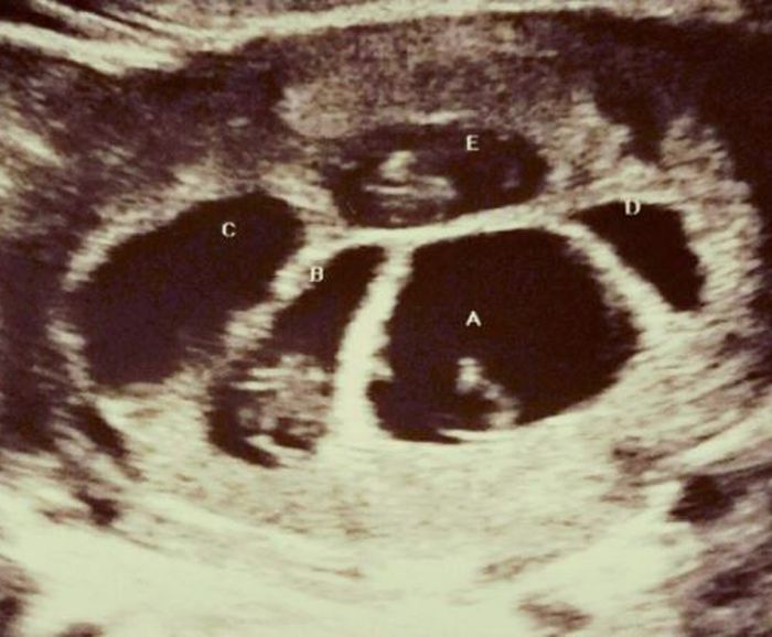 Hasil USG rahim Briana