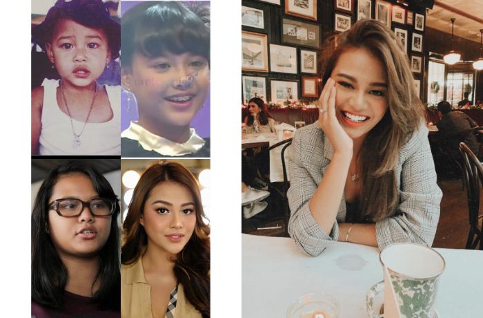 Aurel Hermansyah tampil imut dengan gigi kelinci setelah veneer gigi