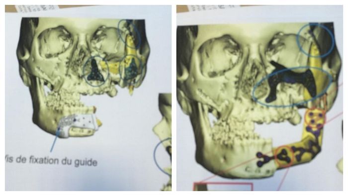 foto tengkorak Gaelle setelah penyerangan dan setelah operasi.
