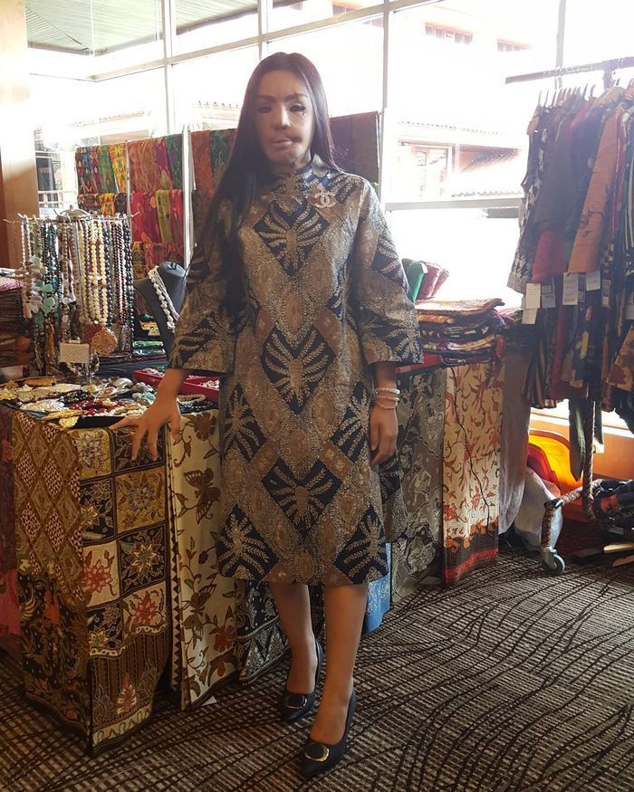 Sempat Hilang, Kini Kabar Lisa Face Off yang Disiram Air Keras Kembali Mencuak